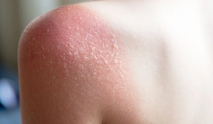 Sonnenbrand Blasen an der Schulter Sonnenbrand Blasen an der Schulter
