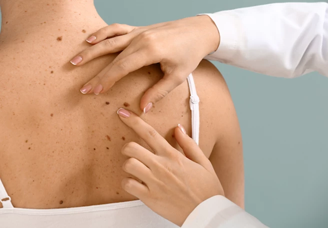 Person bei der Hautkrebsvorsorge Person bei der Hautkrebsvorsorge